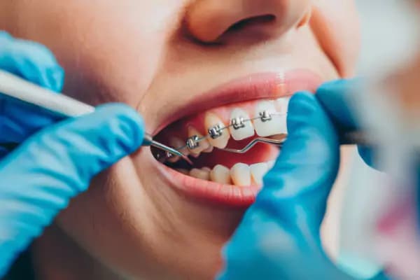 Dental Implants